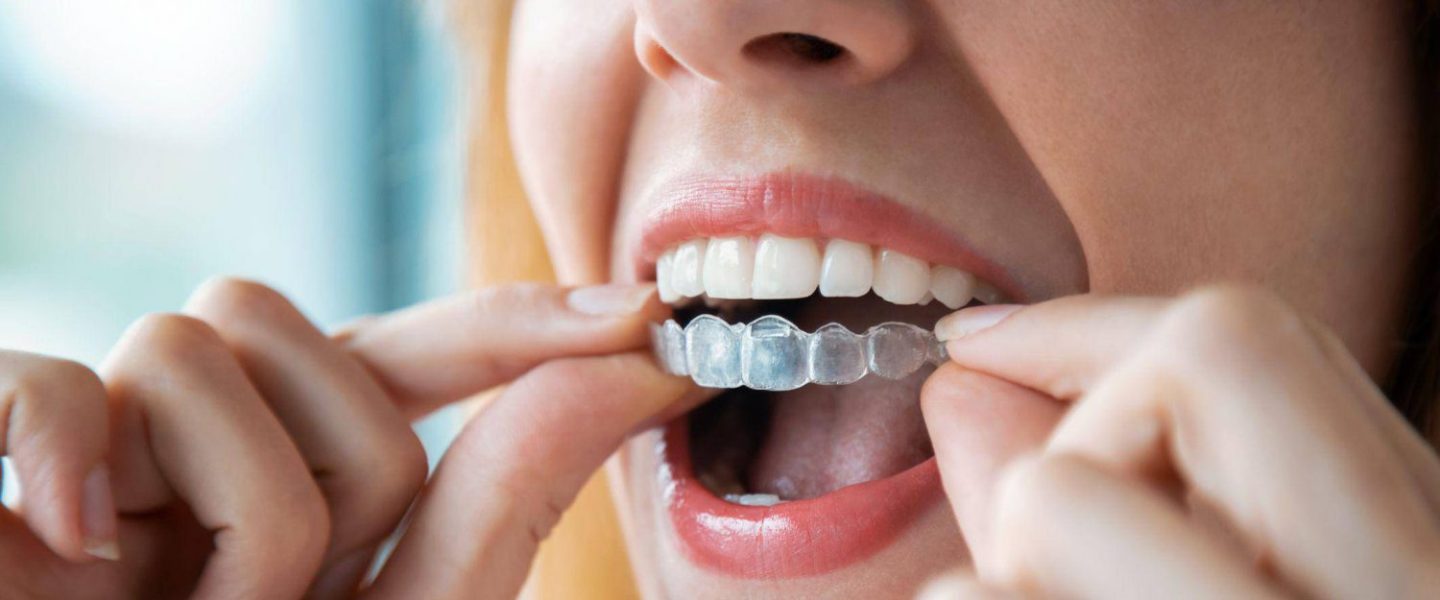 Invisalign in London: Combining Comfort with Effective Smile Correction