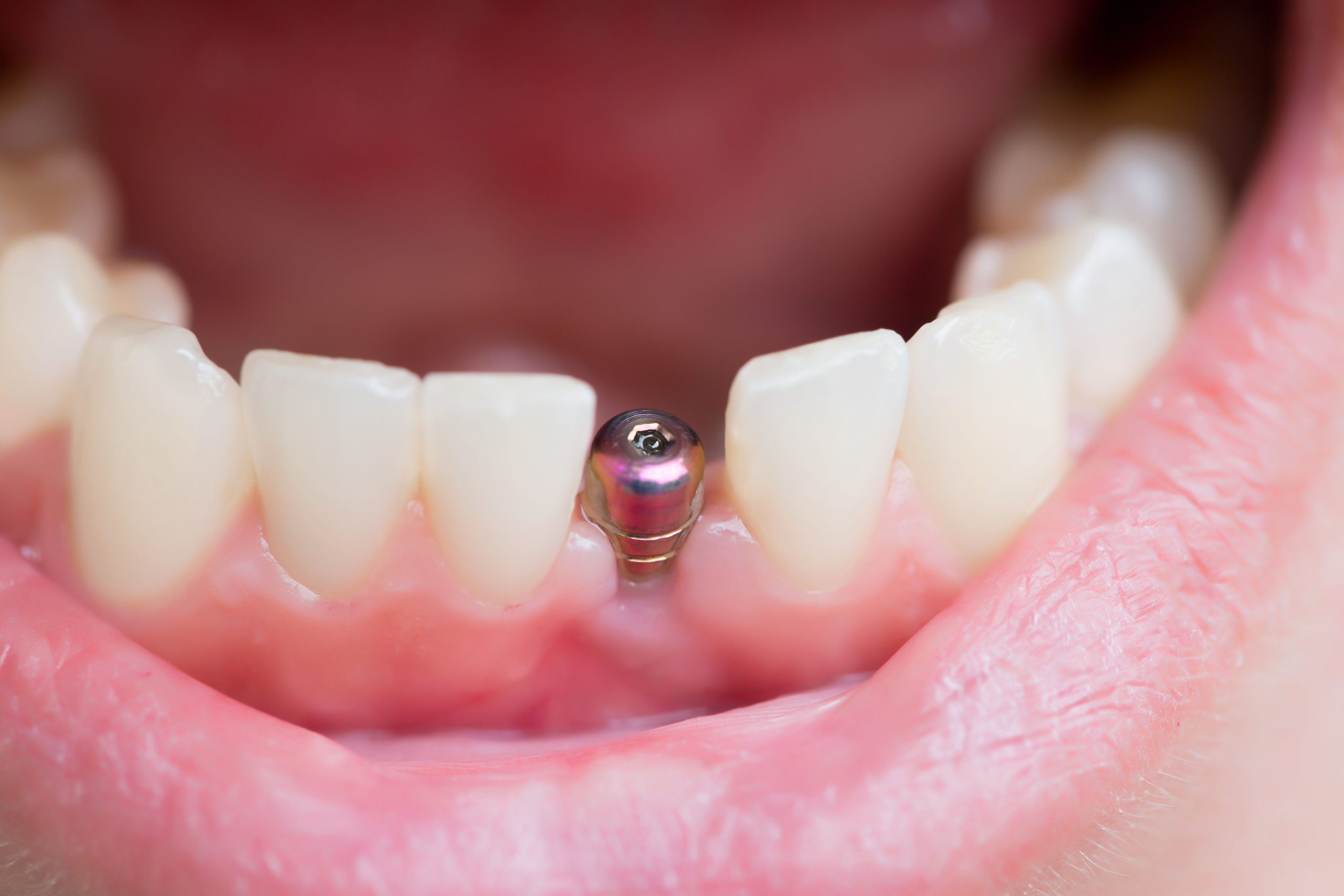 Innovative Approaches to Boosting Oral Health with Dental Implants