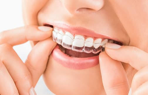 Protecting Your Smile After Invisalign Understanding the Critical Role of Retention in Orthodontic Success